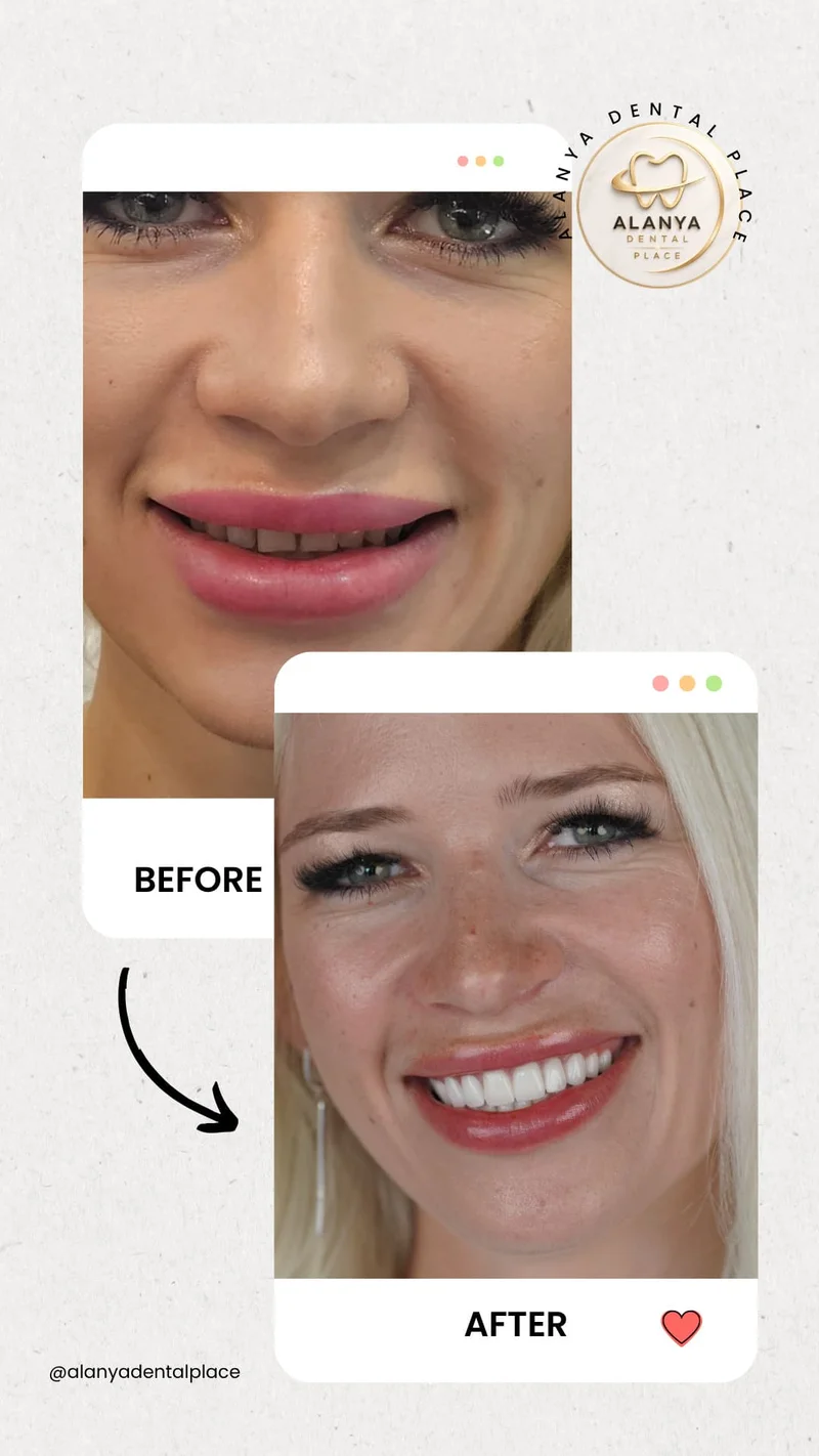 Dental treatment before and after - case 1