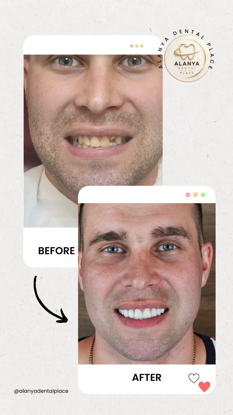 Hollywood Smile before and after - case 1