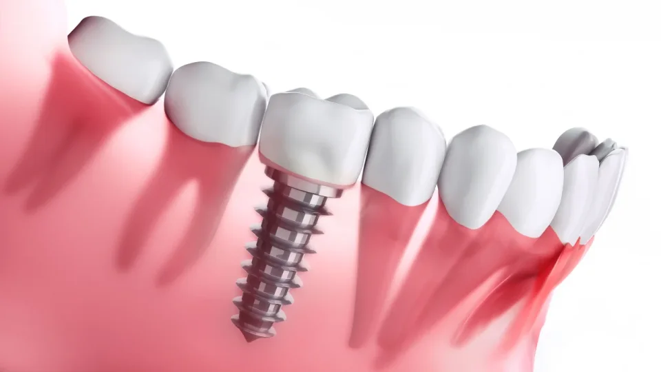 Dental implant smile example in Turkey